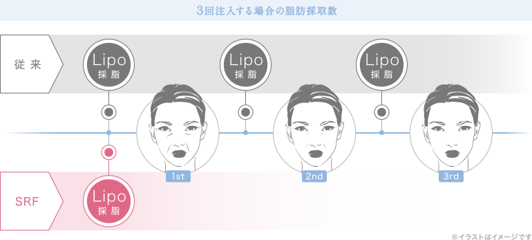 ３回注入する場合の脂肪採取数